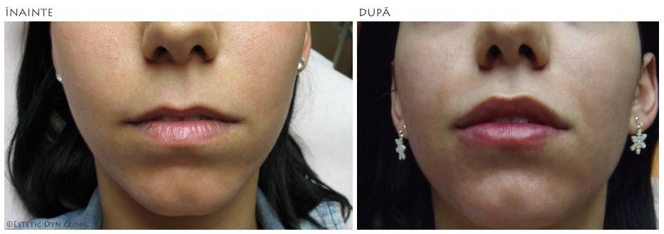 30% reducere la proceduri dermatologice de înfrumusețare cu acid hialuronic la MedLife Oradea!